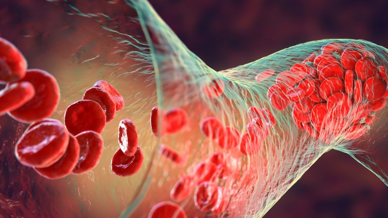 Blutgerinnsel: Erhöhtes Risiko bei Geimpften oder Long-COVID-Patienten mit bestimmten genetischen Faktoren
