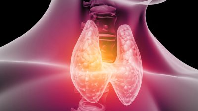 Jodmangel und seine Folgen: Erhöhtes Risiko für Krebs- und Schilddrüsenprobleme