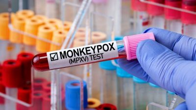 Das Virus ist noch da: Nach langer Ruhe wieder Mpox