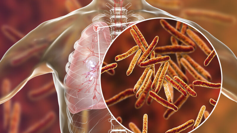 Tuberkulose übertrifft COVID-19 zahlenmäßig als tödlichste Infektionskrankheit
