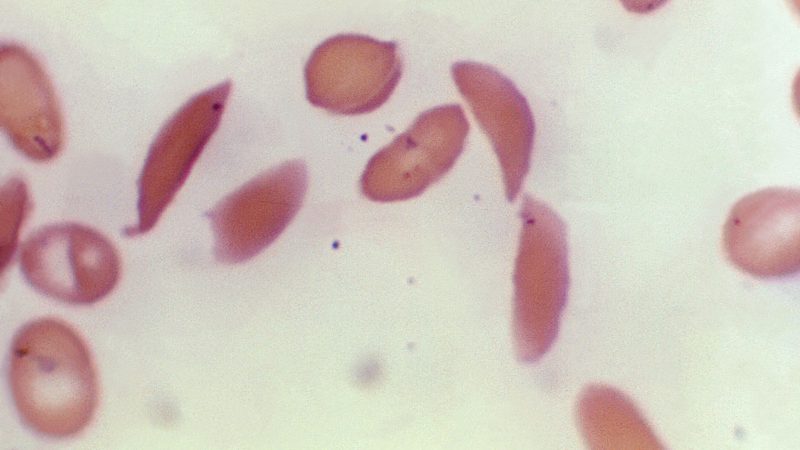 Mikroskopbild zeigt halbmondförmige rote Blutkörperchen eines an Sichelzellenanämie erkrankten Patienten aus dem Jahr 1972.
