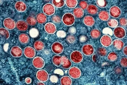 Sprunghafter Anstieg der Mpox-Infektionen im Kongo &#8211; WHO befürchtet Ausbreitung
