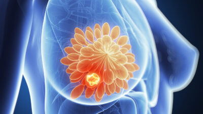 Wissenschaftler entwickeln Heilgel gegen Brustkrebs
