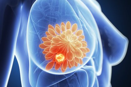 Wissenschaftler entwickeln Heilgel gegen Brustkrebs