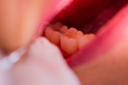 Zahnarzt bohrt versehentlich Schraube in Gehirn von Patienten