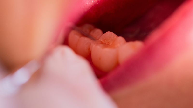 Zahnarzt bohrt versehentlich Schraube in Gehirn von Patienten