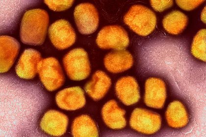 Bei Köln: Schule wegen Mpox vorsorglich geschlossen