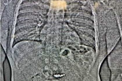 Dieb verschluckt Ohrringe – Beweisfindung per Röntgenbild