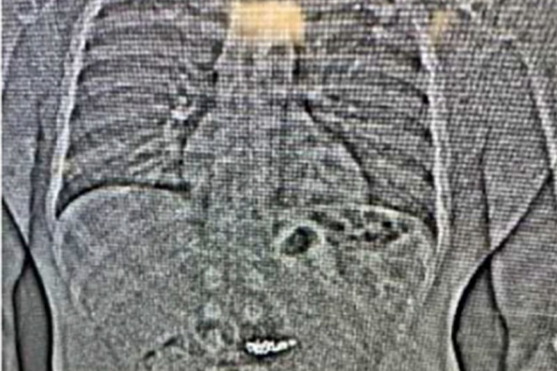 Beweisfindung per Röntgenbild: Einem Mann in Florida wird vorgeworfen, gestohlene Ohrringe im Wert von mehreren Hunderttausend Dollar verschluckt zu haben.