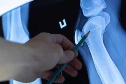 Wenn die Knochen brüchig werden: Osteoporose erkennen, bevor es kracht