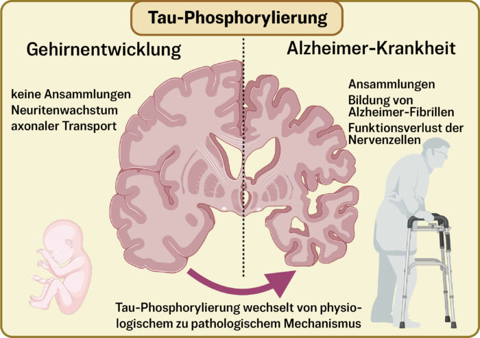 Möglicher Auslöser für Alzheimer