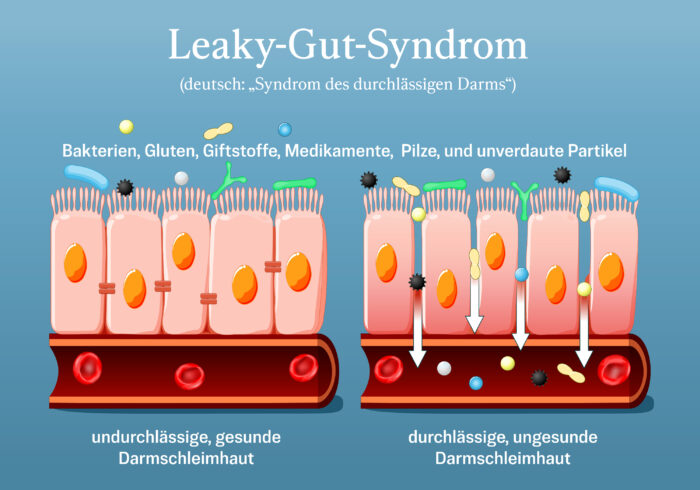 Leaky-Gut-Syndrom