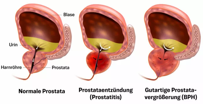 Krankheitsbedingte Veränderungen der Prostata