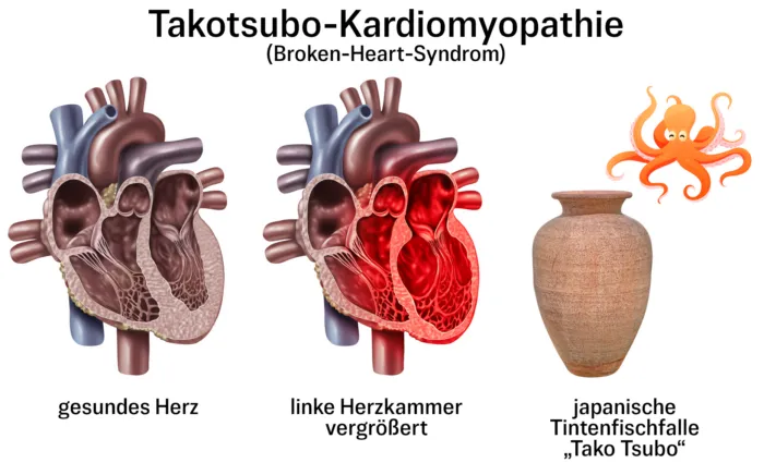 Die Form der vergrößerten linken Herzkammer eines gebrochenen Herzens erinnerte die japanischen Forscher an eine Tintenfischfalle.